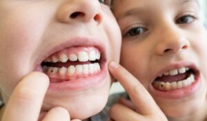 What Are the Signs of Tooth Decay in Children